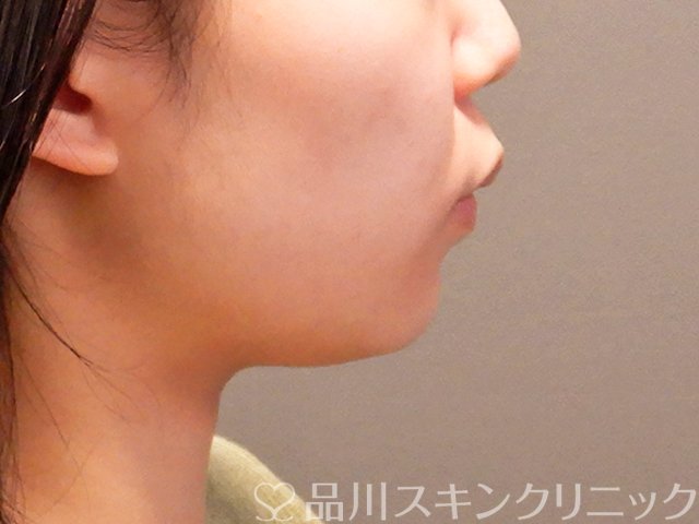 症例NO.69914のBEFORE写真