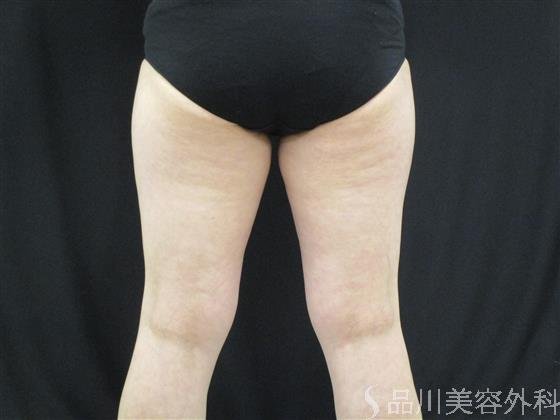 症例NO.54099のBEFORE写真