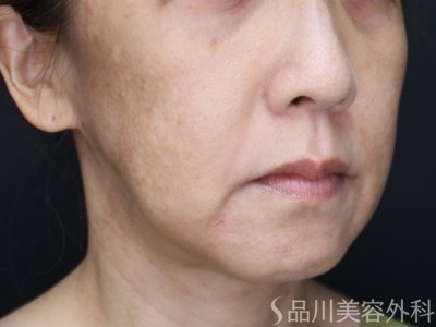 症例NO.71497のBEFORE写真