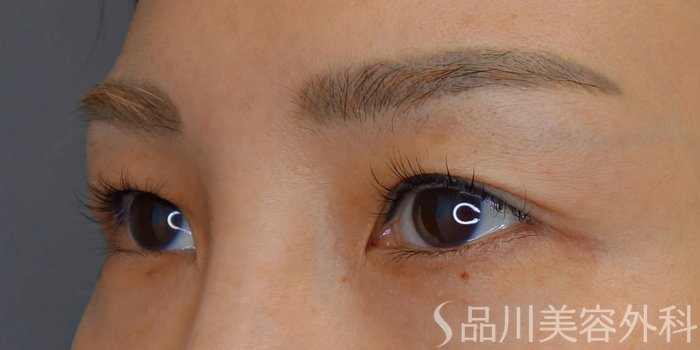 症例NO.72155のBEFORE写真