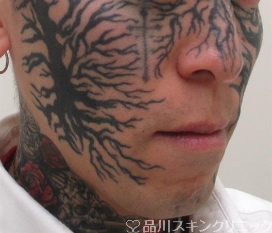 症例NO.26721のBEFORE写真