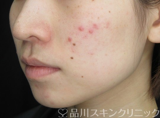 症例NO.70265のBEFORE写真