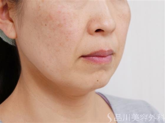 症例NO.38584のBEFORE写真