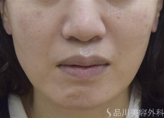症例NO.51623のAFTER写真