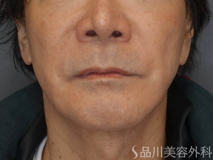 症例NO.72093のBEFORE写真