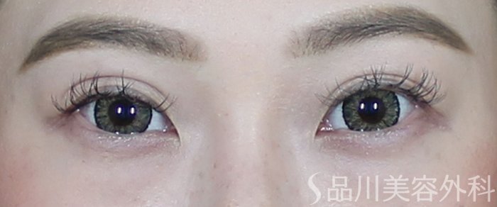 症例NO.73033のAFTER写真