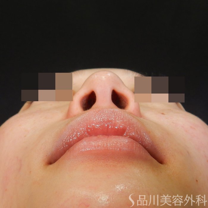 症例NO.65087のBEFORE写真