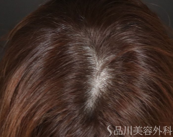 症例NO.73300のAFTER写真