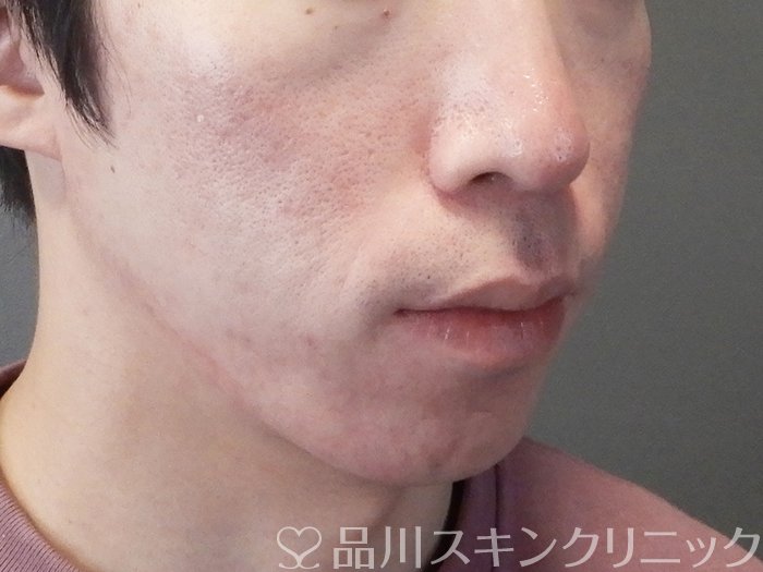 症例NO.67043のAFTER写真