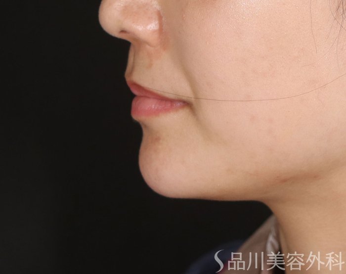 症例NO.73751のBEFORE写真