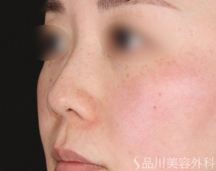 症例NO.73191のBEFORE写真