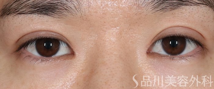 症例NO.70869のAFTER写真