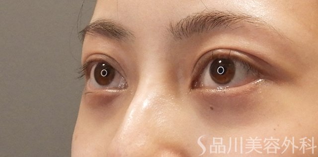 症例NO.74433のAFTER写真