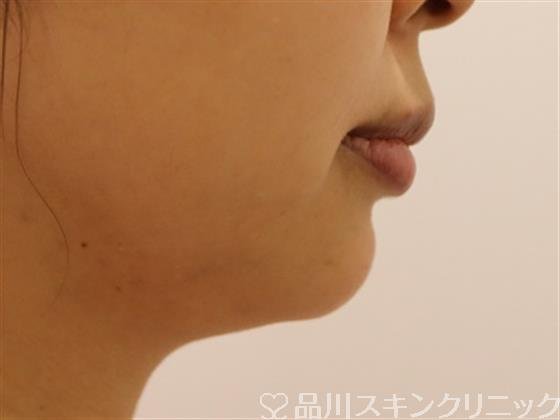 症例NO.40932のAFTER写真