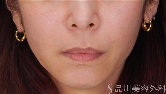 症例NO.55757のAFTER写真
