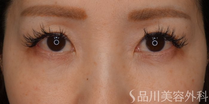 症例NO.73235のBEFORE写真