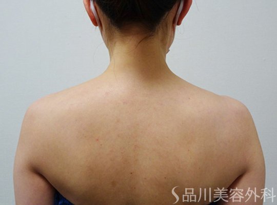 症例NO.67468のBEFORE写真