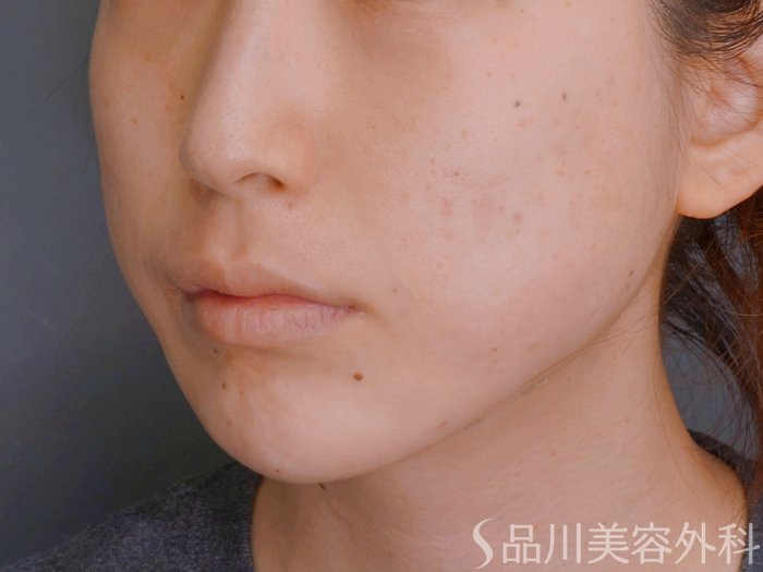 症例NO.73636のAFTER写真