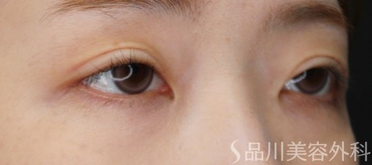 症例NO.71896のAFTER写真