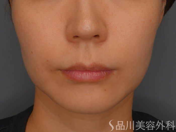 症例NO.73694のBEFORE写真