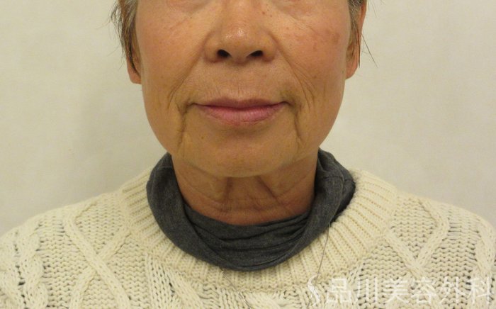 症例NO.72253のBEFORE写真