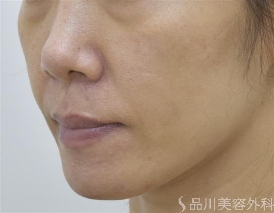 症例NO.54260のBEFORE写真