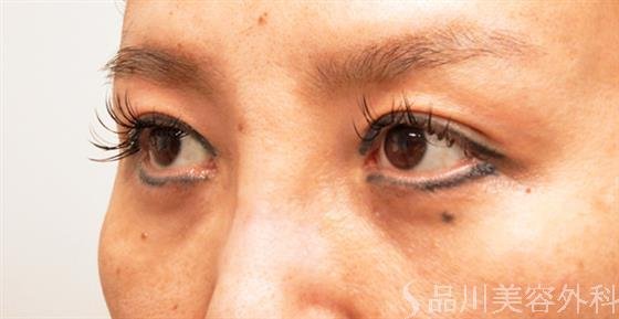 症例NO.53019のAFTER写真