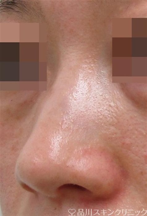 症例NO.52758のBEFORE写真