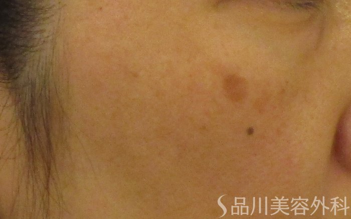 症例NO.65272のBEFORE写真