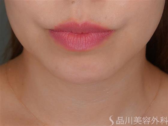 症例NO.52256のBEFORE写真