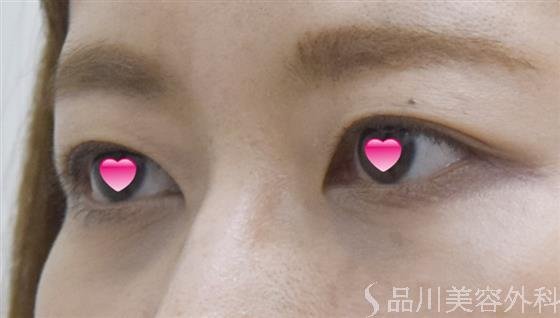 症例NO.52437のAFTER写真