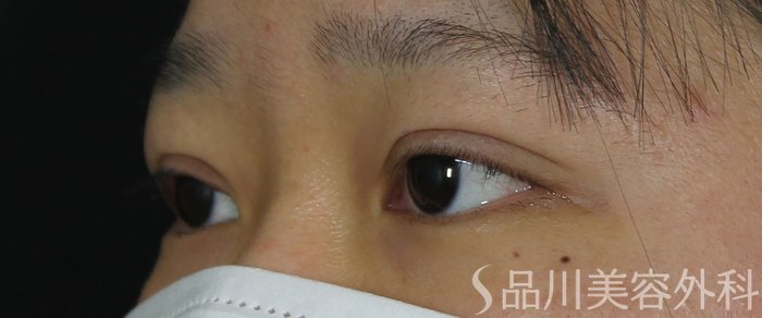 症例NO.71892のAFTER写真