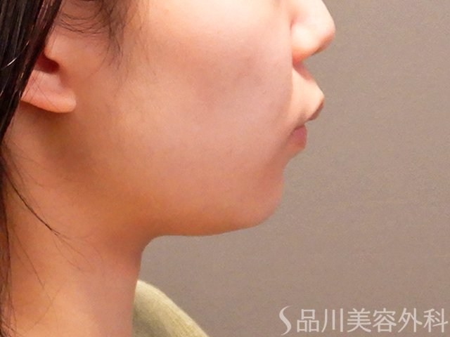 症例NO.69914のBEFORE写真