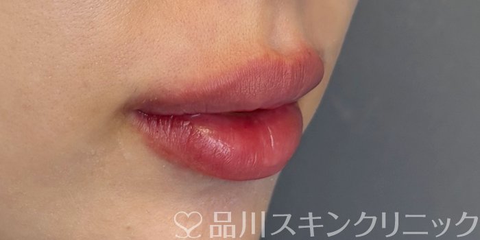 症例NO.71732のAFTER写真