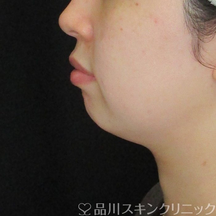 症例NO.74296のBEFORE写真