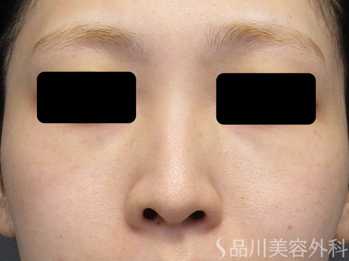 症例NO.75153のBEFORE写真