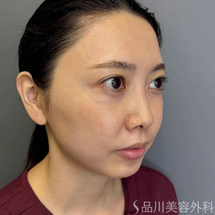 症例NO.71188のBEFORE写真