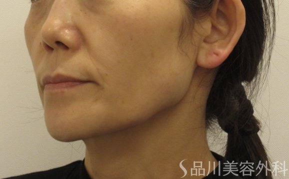 症例NO.72707のBEFORE写真