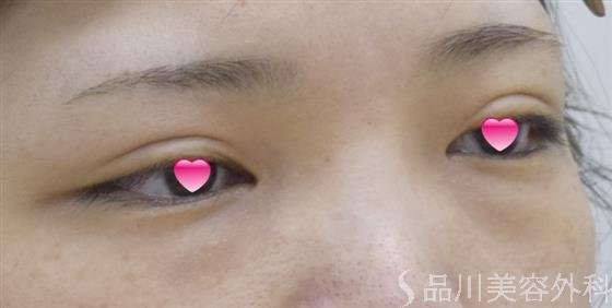 症例NO.53163のBEFORE写真