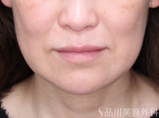 症例NO.73386のAFTER写真