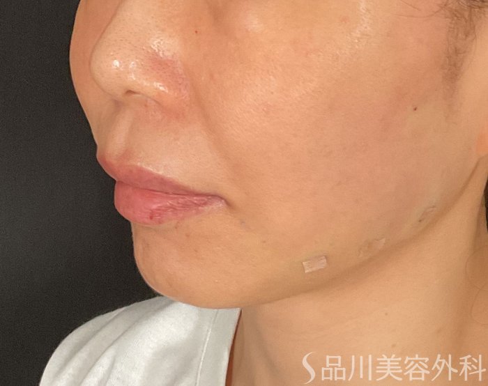 症例NO.75209のAFTER写真