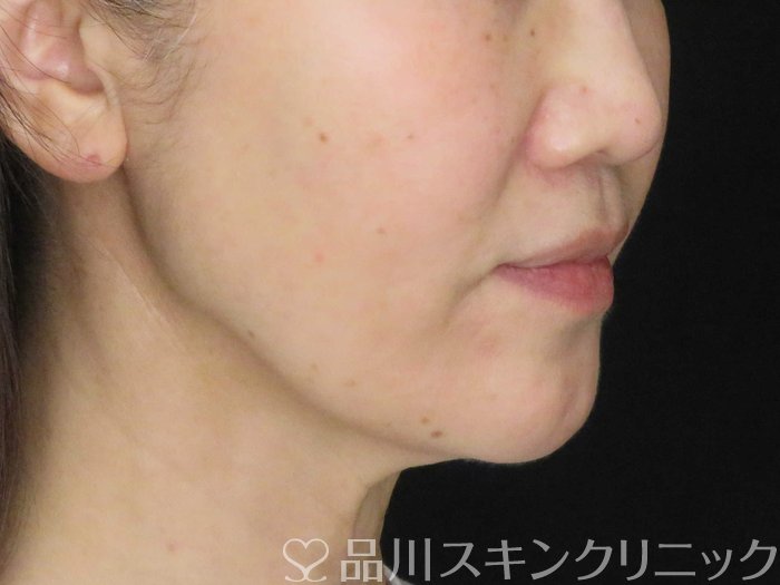 症例NO.65063のBEFORE写真