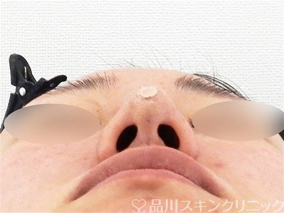 症例NO.56741のAFTER写真