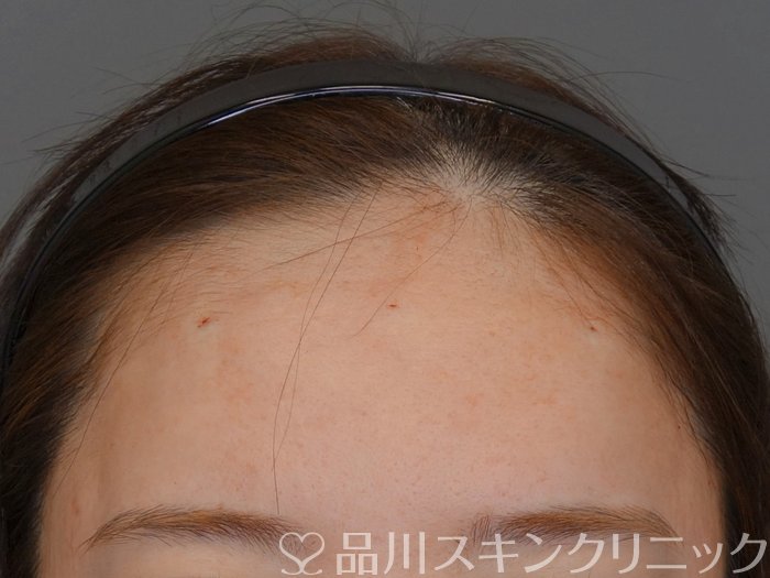 症例NO.74120のAFTER写真