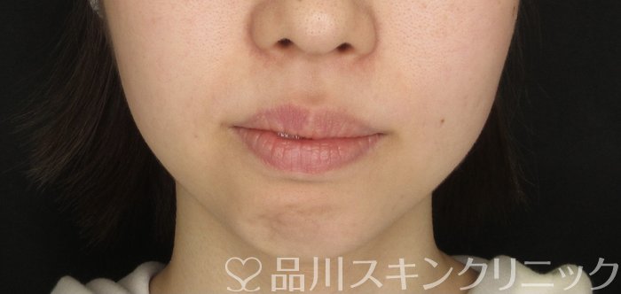 症例NO.69524のBEFORE写真