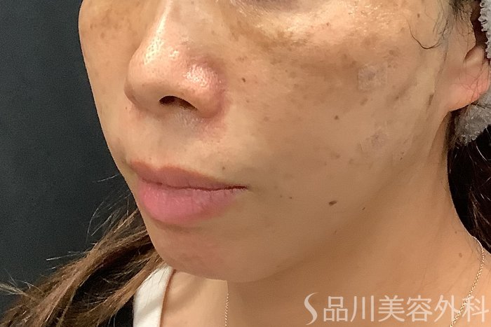 症例NO.67807のAFTER写真