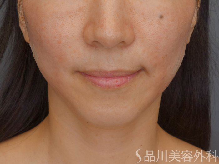 症例NO.72044のAFTER写真