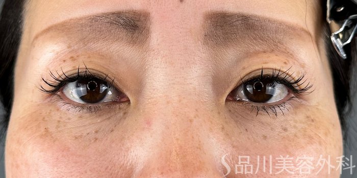 症例NO.70181のAFTER写真