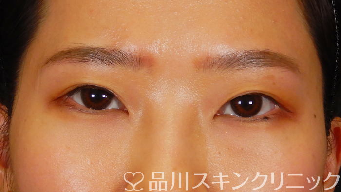 症例NO.62820のAFTER写真
