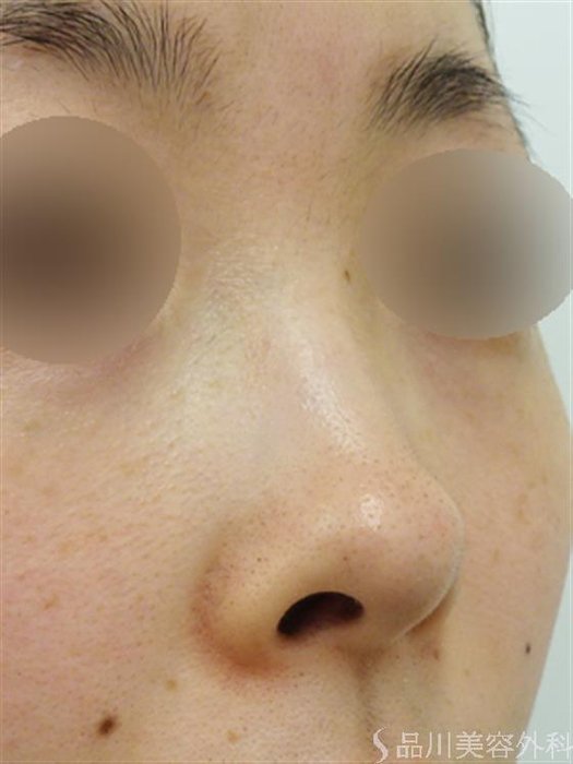 症例NO.44532のBEFORE写真